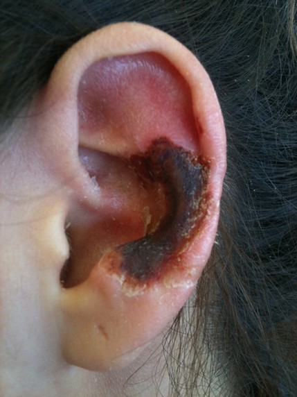 Последствия отопластики в виде некроза хряща уха